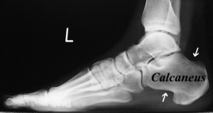 049 Figure-1A-Normal-lateral-foot-x-Ray-1024x547