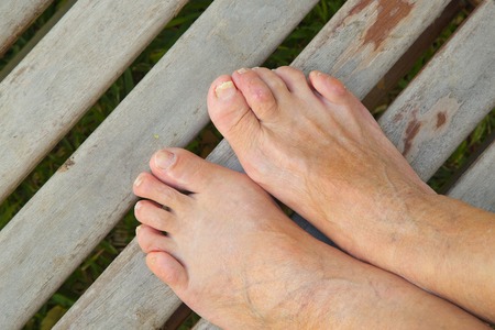 Facts about Hammertoes